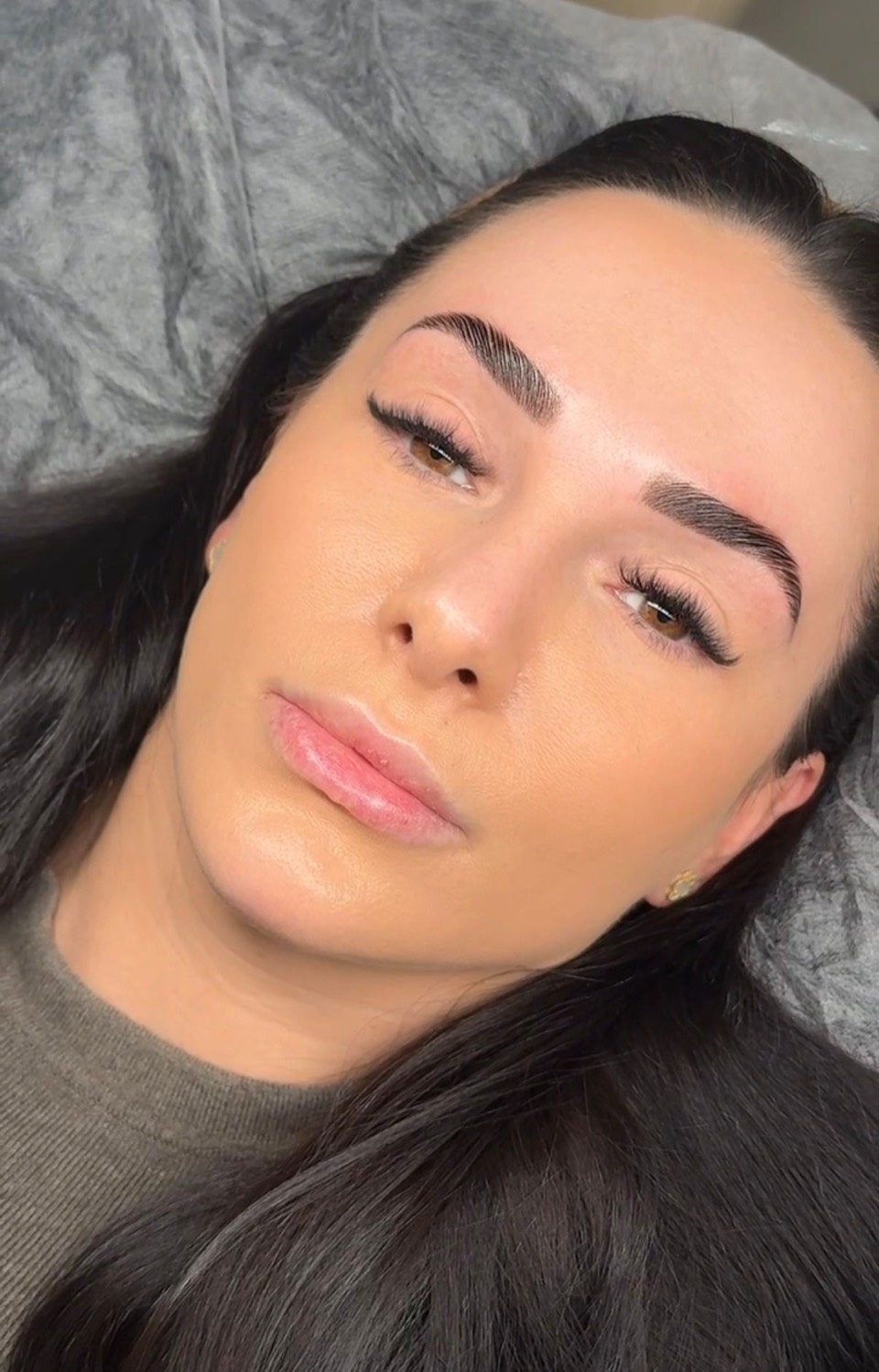 Brow Lifting – natürliches Ergebnis